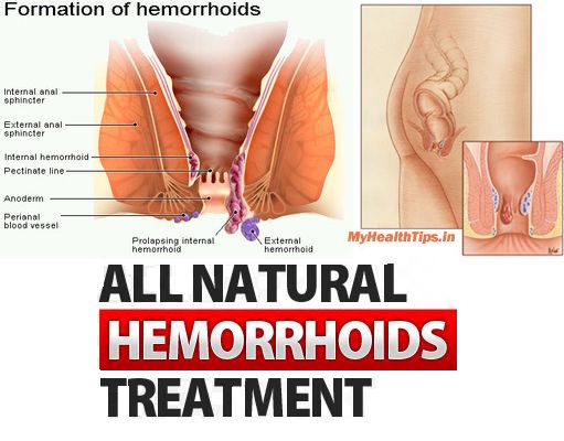 Natural Treatment For Piles At Home Natural Treatment For Piles At Home