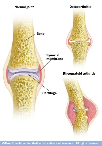 Natural Cures For Synovial Inflammation Natural Cures For Synovial Inflammation