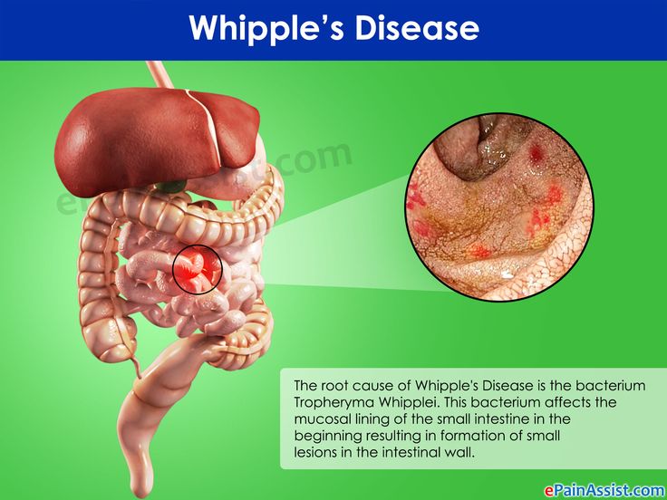 Whipple Disease Natural Treatment Whipple Disease Natural Treatment