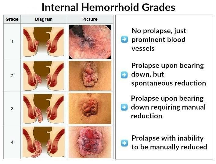 7 Natural Cures for Hemorrhoids - Get Relief in 24 Hours or Less