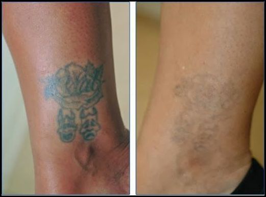 the 25 best tattoo removal cost ideas on pinterest tattoo the 25 best tattoo removal cost ideas on pinterest tattoo