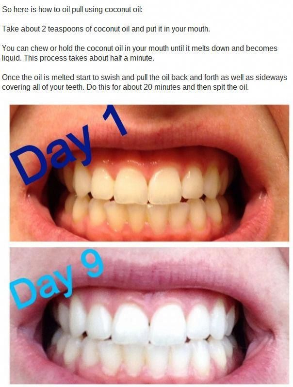 Best way to pull a tooth