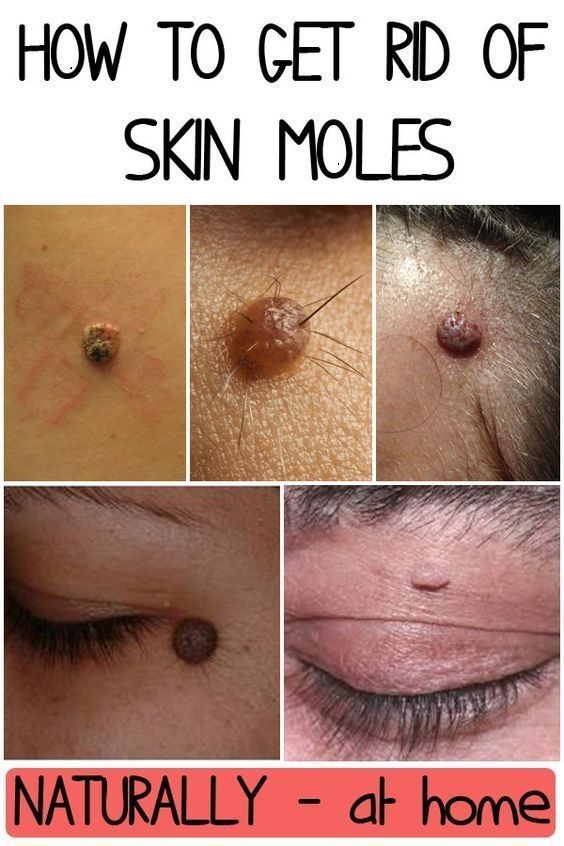 How To Get Rid Of A Facial Mole Naturally How To Get Rid Of A Facial Mole Naturally
