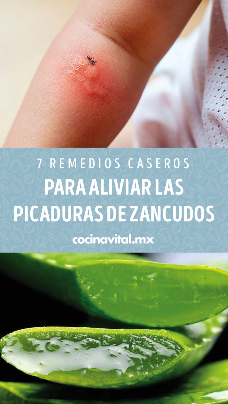 7 Remedios Caseros Para Aliviar Las Picaduras De Zancudos Cocina Vital Qué Cocinar Hoy Picaduras De Zancudos Remedios Para Mosquitos Picaduras