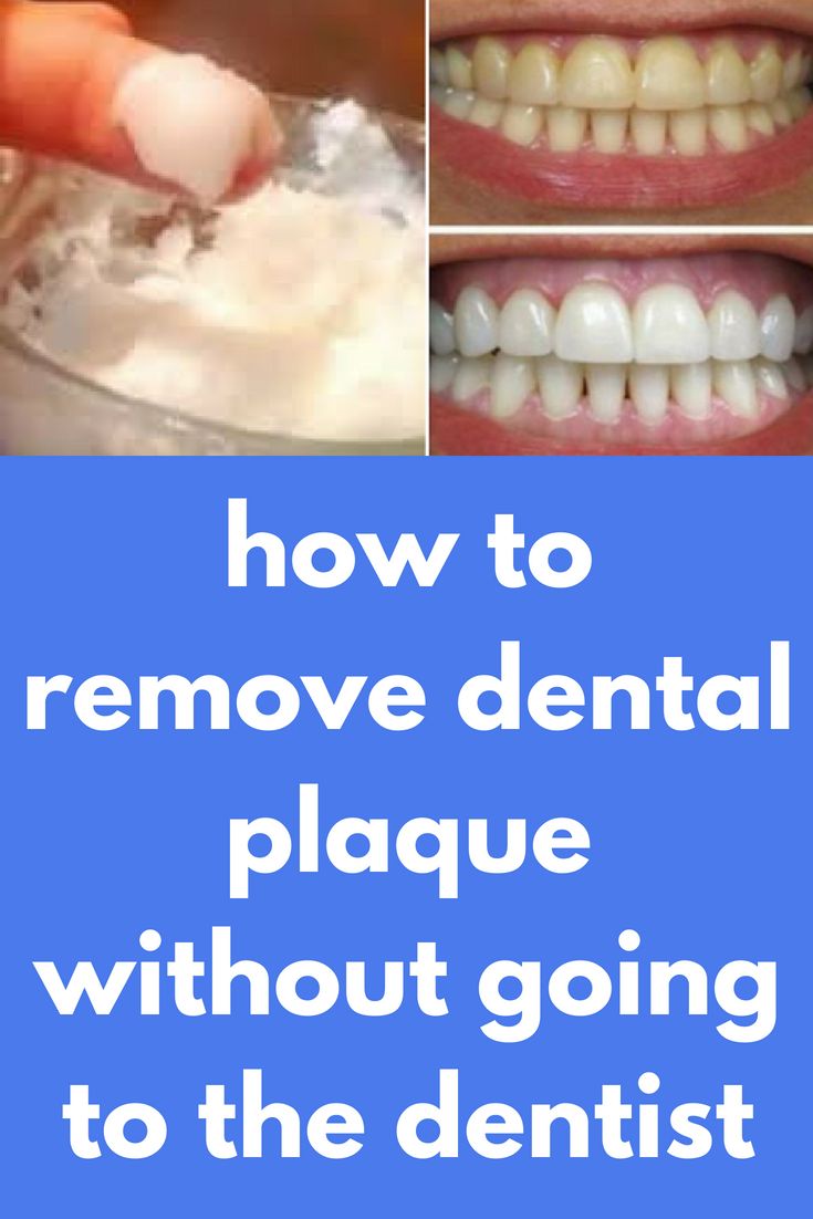 how to remove dental plaque without going to the dentist