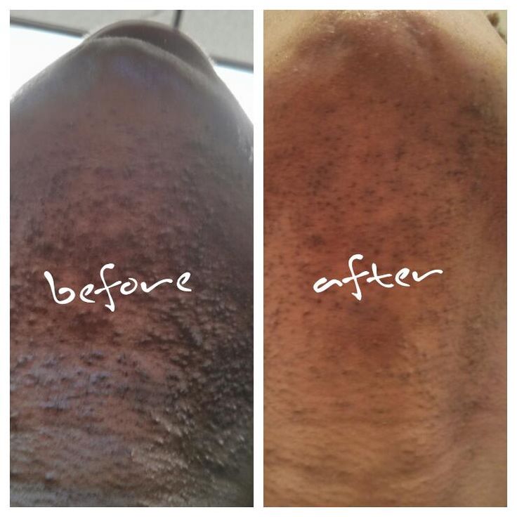 Pityrosporum Folliculitis Face Natural Treatment Pityrosporum Folliculitis Face Natural Treatment