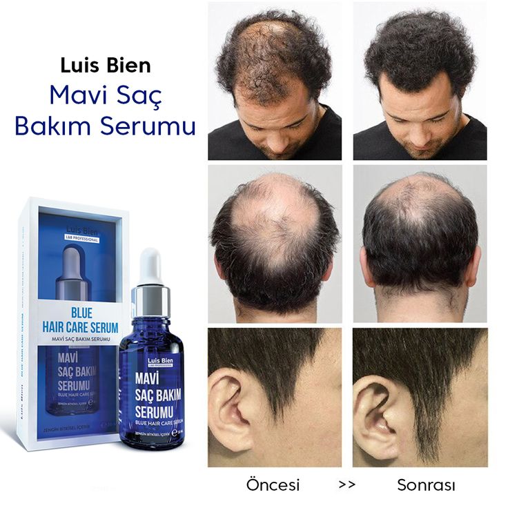 Sac Seyrekligine Son Mavi Sac Serum Sac Sac Seyrekligine Son Mavi Sac Serum Sac