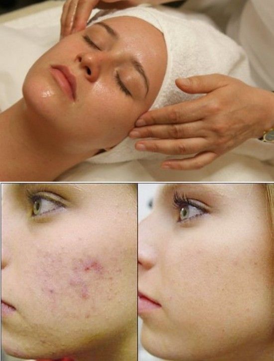 Facial black mole homeopath medicine remova good see