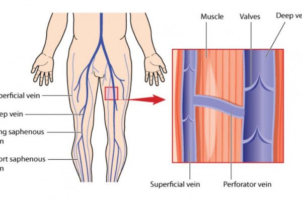 varicoză și tratament hormonal