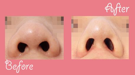 Non incision nose surgery before and after photo ☞ Required duration of stay i...