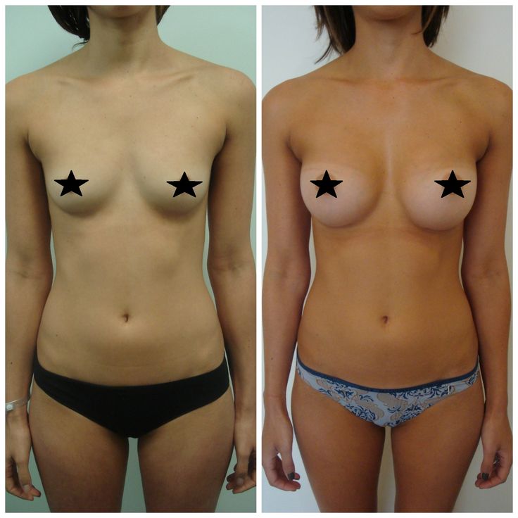 Natural Breast Implants 5