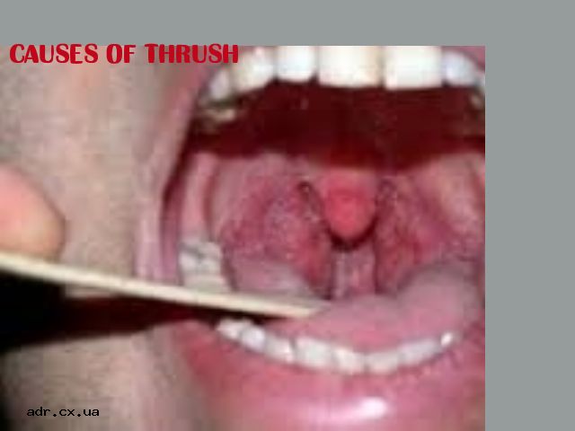 Untreated thrush
