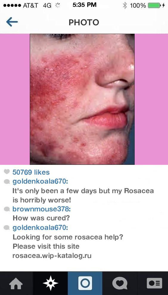 Hypertension rosacea arthritis