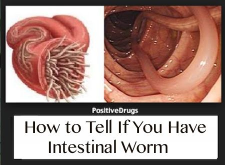 how to if has worms 93 how to check for parasites in stool how do you if your has worms 5 how to if has worms 93 how to check for parasites in stool how do you if your has worms 5