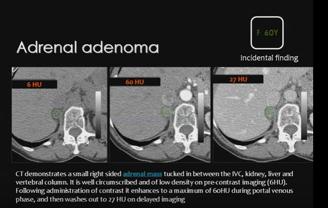 adrenal adenoma washout administration enhancement surgical nurse