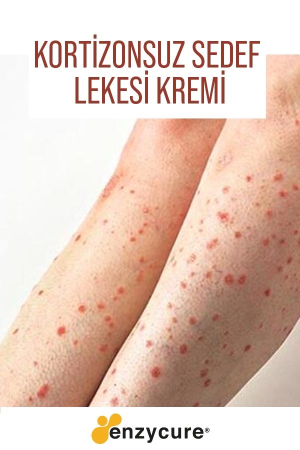 Kortizonsuz Sedef Lekesi Kremi Dogal Krem Cil Kortizonsuz Sedef Lekesi Kremi Dogal Krem Cil