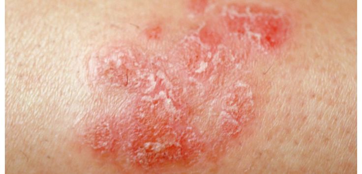 Best 25+ Traitement psoriasis ideas that you will like on Best 25+ Traitement psoriasis ideas that you will like on