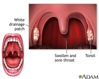 Peroxide strep throat