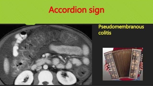 Accordion sign in 2020 Pseudomembranous colitis, Accordion, Signs Accordion sign in 2020 Pseudomembranous colitis, Accordion, Signs