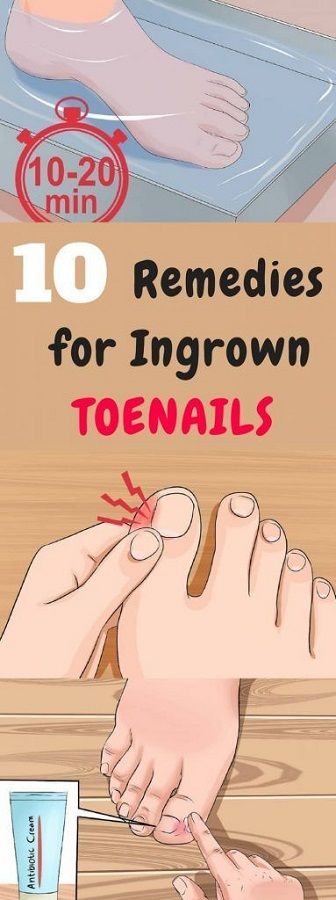6 NATURAL REMEDIES FOR INGROWN TOENAILS