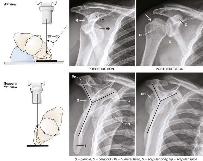Y VIEW SHOULDER POSITIONING XR Radiology Student Radiology Imaging y-view-shoulder-positioning-xr-radiology-student-radiology-imaging