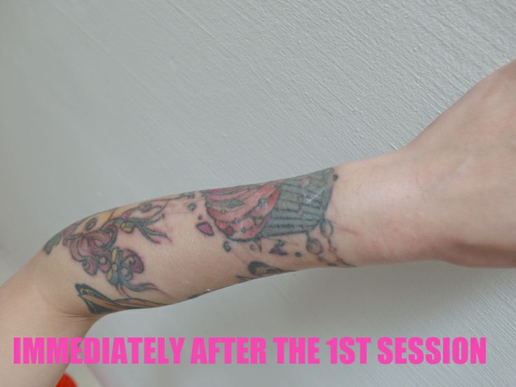 28 best tattoo removal images on pinterest do you before and 28 best tattoo removal images on pinterest do you before and