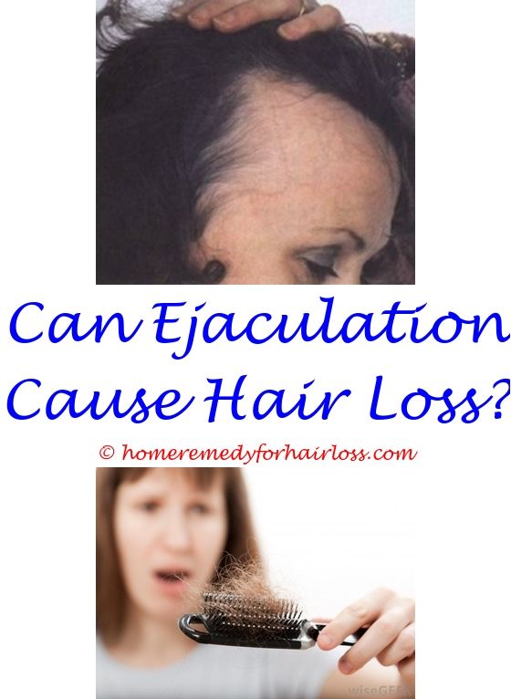 15 best Hair Loss 15 images on Pinterest