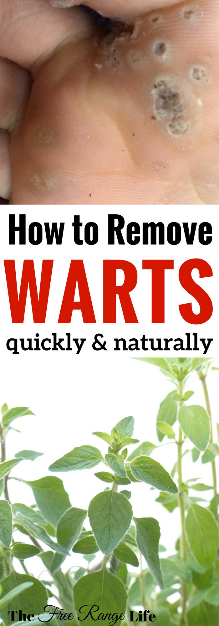 Get Rid Of Warts Naturally Get Rid Of Warts Naturally