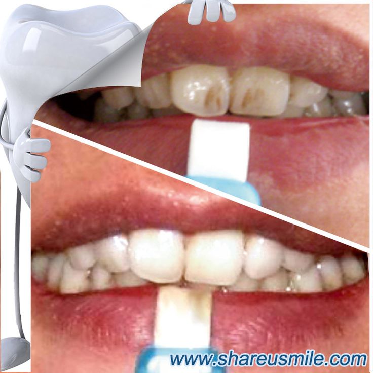 How Much Does It Cost To Start A Teeth Whitening Business ...