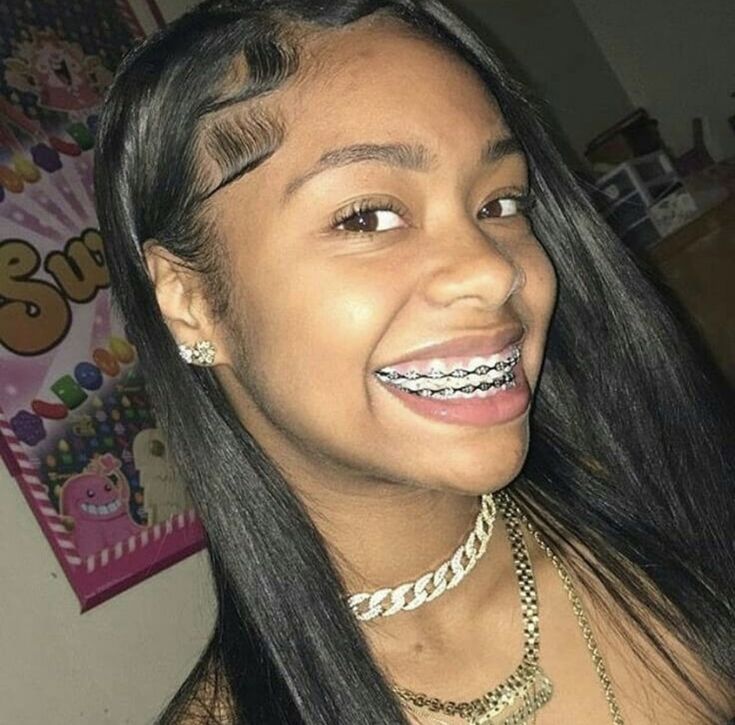 Hot girls with braces Hot girls with braces