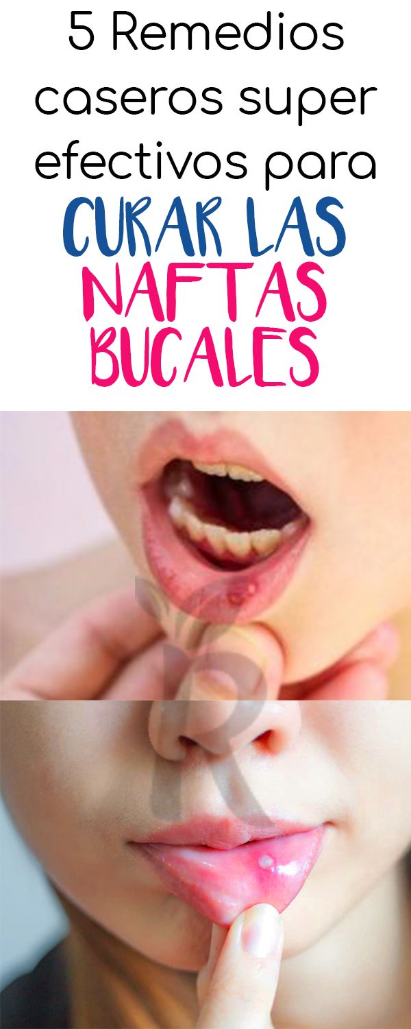 Remedios Caseros Para Llagas En La Boca Aftas Bucales Llagas En La Lengua Ulceras Bucales Estomatitis Aftosa