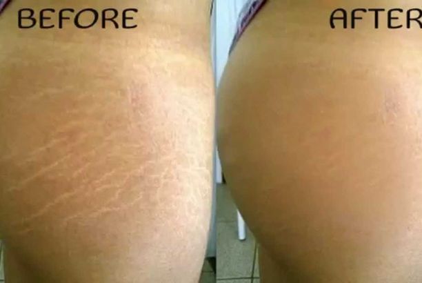 How To Get Rid Of C Diff Naturally How To Get Rid Of C Diff Naturally