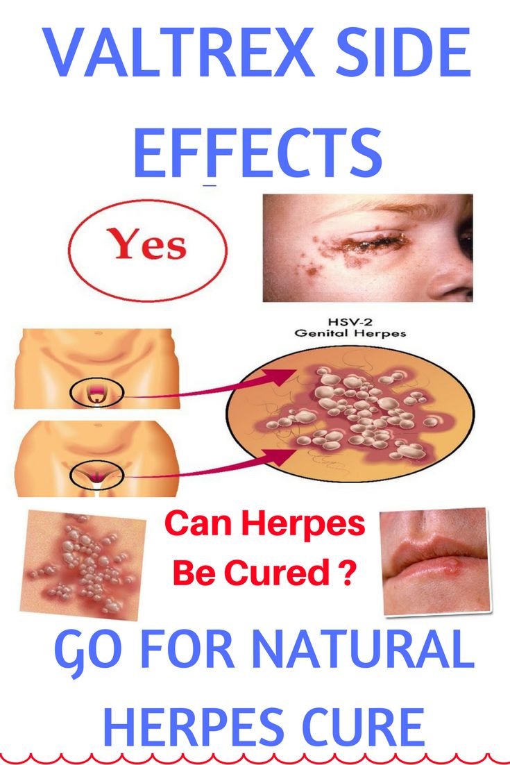 Herpes Eye Infection Natural Cure Herpes Eye Infection Natural Cure