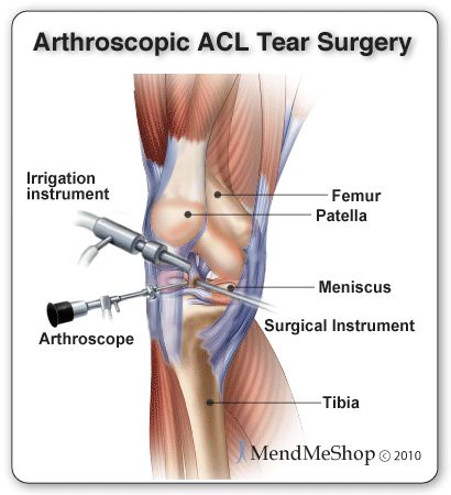 acl surgery recovery best 25 acl surgery ideas on acl surgery recovery acl tear recovery and acl surgery recovery best 25 acl surgery ideas on acl surgery recovery acl tear recovery and