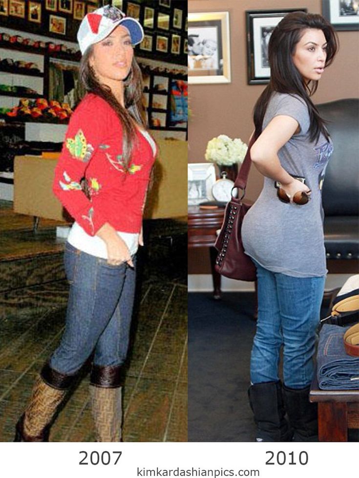 Anal bleach kim kardashians but before and after — img 4