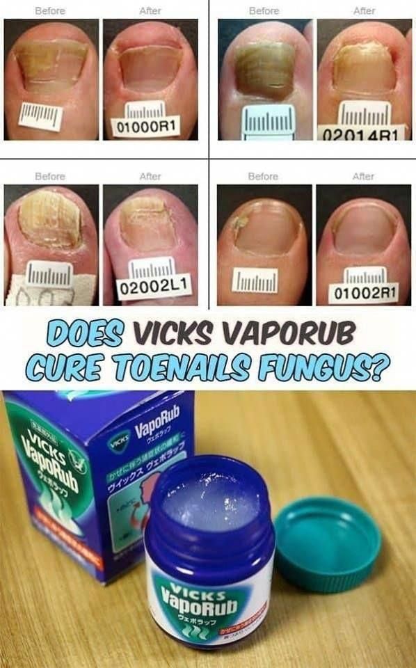 vicks vaporub for toenail fungus work vicks vaporub for toenail fungus work
