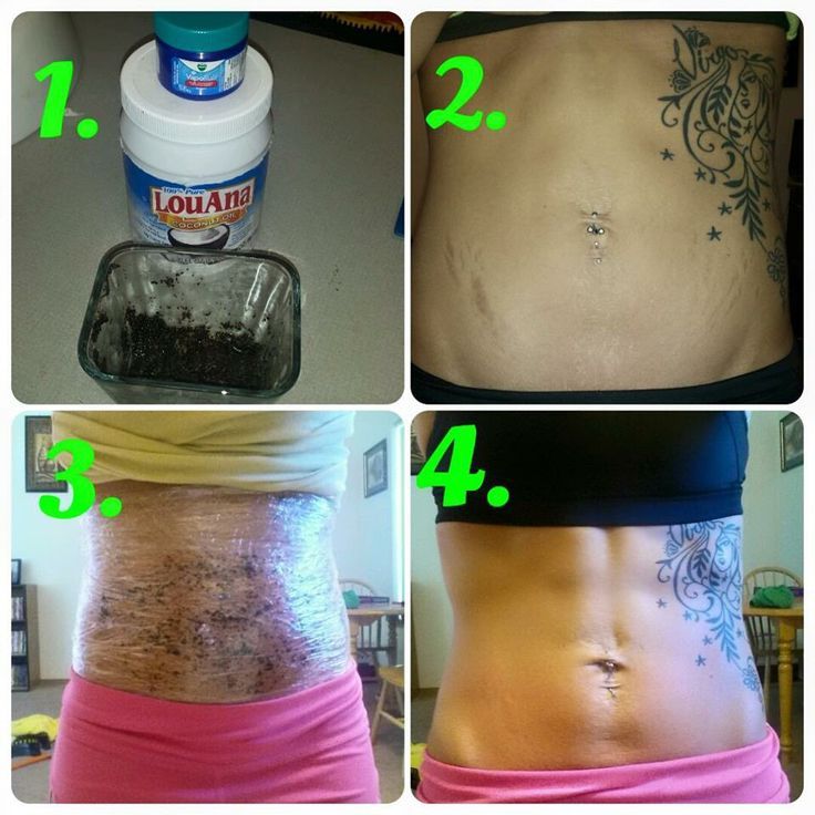 10 Stretch Mark Remedies That Actually Work | Body wraps recipe Coconut Oil Body Wrap For Weight Loss