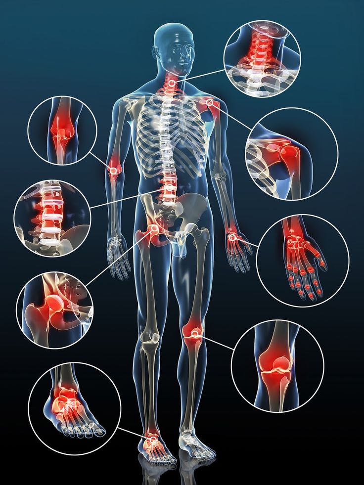 Naturheilmittel bei Arthrose Naturheilmittel können helfen, die Symptome der Ar...