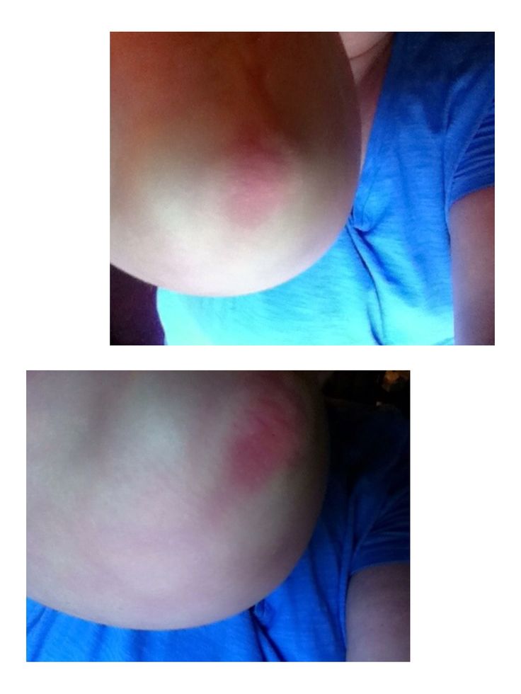 gottron s papules on elbows in dermatomyositis gottron s papules on elbows in dermatomyositis