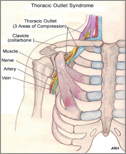 cervical rib thoracic outlet syndrome overview diagnosis