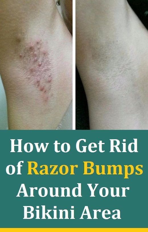 Best of How to avoid razor burn in the bikini area Double handjob cum first stories