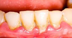 Prenez-en une cuillère à soupe par jour pour sauver vos dents - Éliminez la plaque de façon simple et naturelle