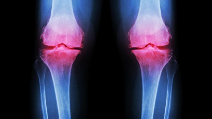 Arthrose im Knie kann die Beweglichkeit erheblich einschränken. (Quelle: Thinks...