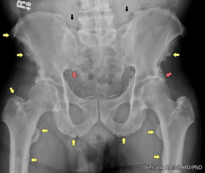 Ankylosing Spondylitis Lumbar Spine And Pelvis Sacroiliac Joint Sacroiliac Ankylosing Spondylitis