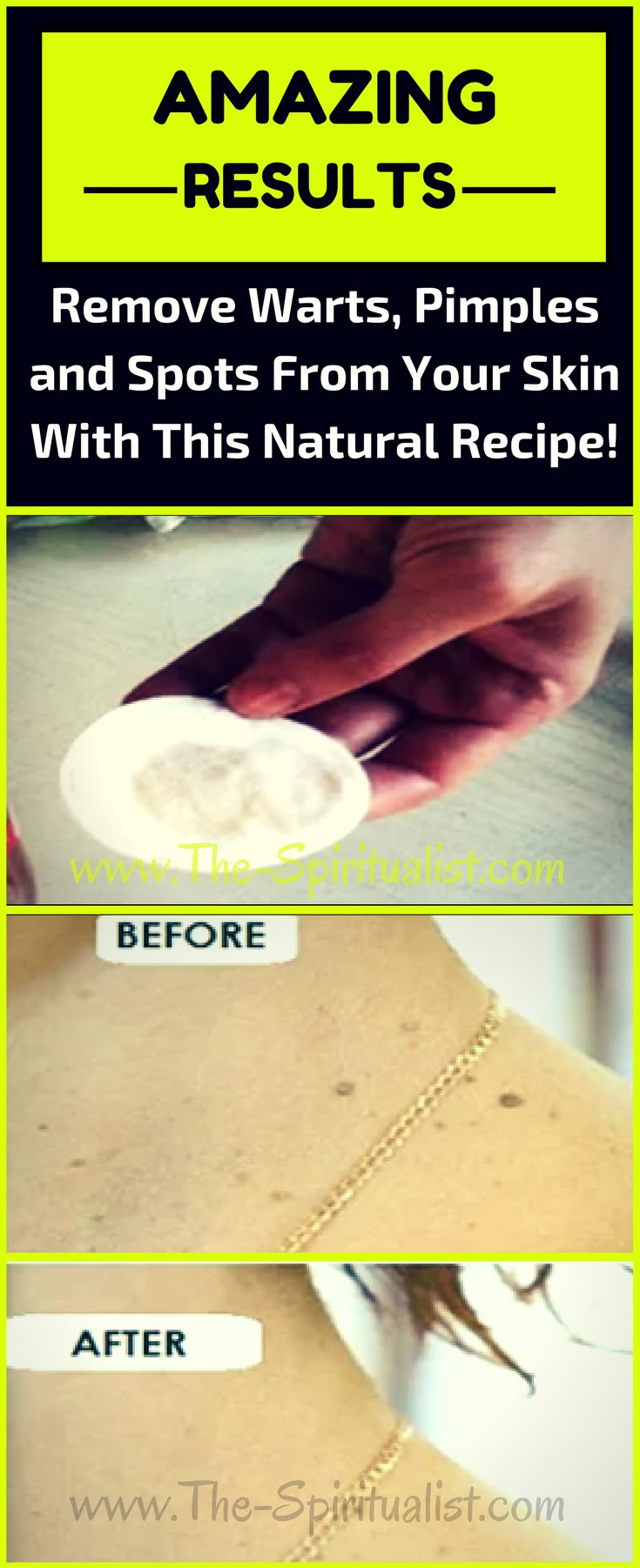 Age Spot Removal Natural Way Age Spot Removal Natural Way
