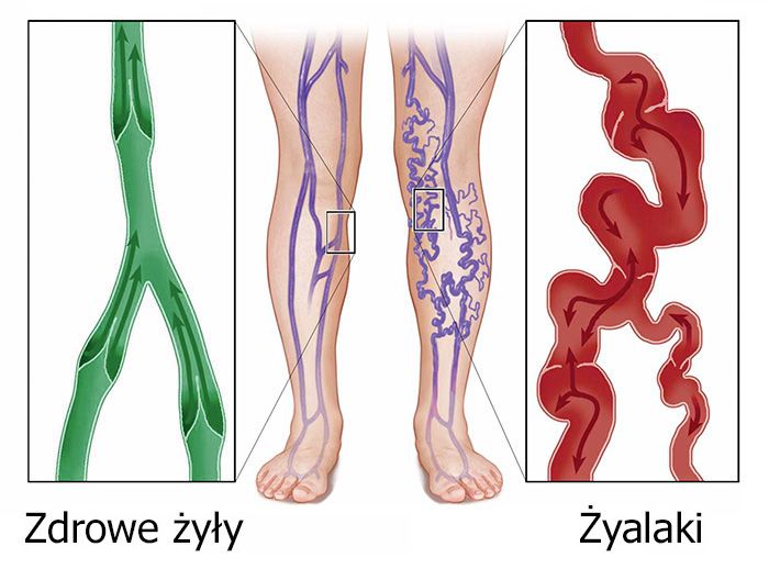 zsírégető rodzaje életkert zsírégető
