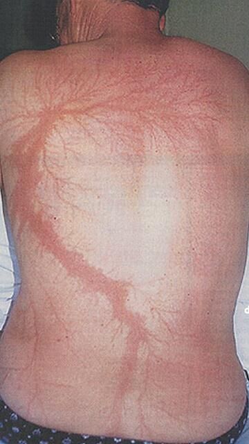 lightning scars images lightning scars images