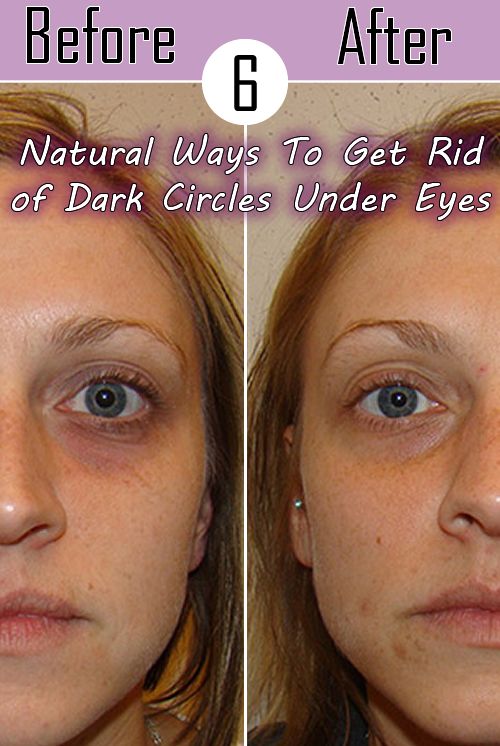 Natural Ways To Get Rid Of Black Circles Under Eyes Natural Ways To Get Rid Of Black Circles Under Eyes