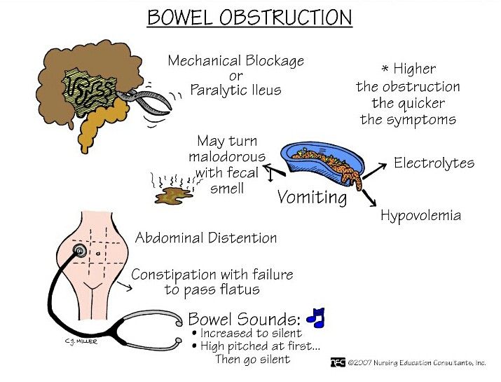 Can I Drink Water With A Bowel Obstruction Can I Drink Water With A Bowel Obstruction