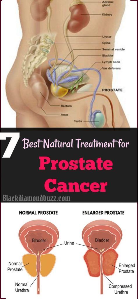 Can You Cure Prostate Cancer Naturally Can You Cure Prostate Cancer Naturally